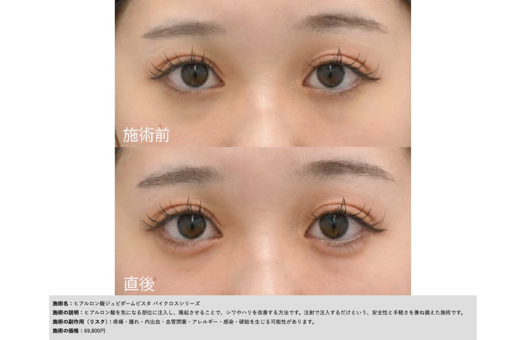 ジュビダーム ボルベラ｜唇や目元に適した自然な仕上がり