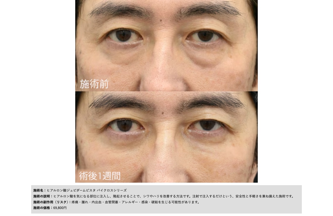 ジュビダーム ボリューマ｜リフトアップ効果や持続期間