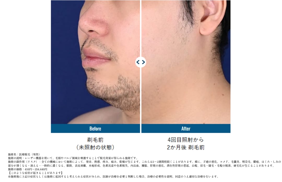 ■医療脱毛