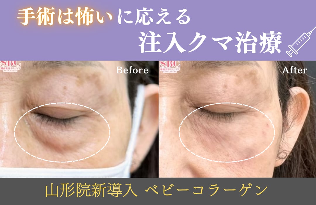 赤ちゃんのようなハリを呼び覚ます「ベビーコラーゲン」｜目の下のクマ・小じわを根本から解決する次世代の肌再生治療