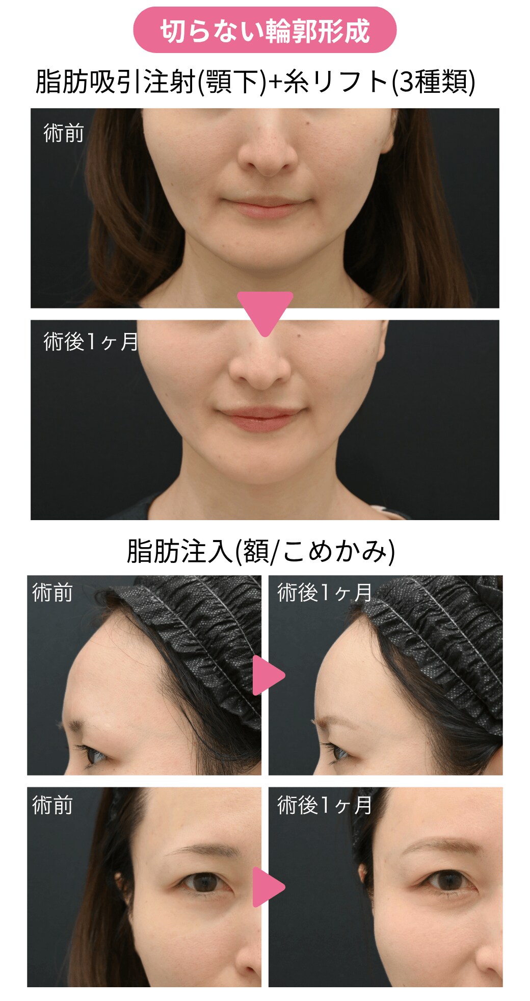 ▶︎ 30代後半女性｜脂肪注入＋脂肪吸引注射＋糸リフト