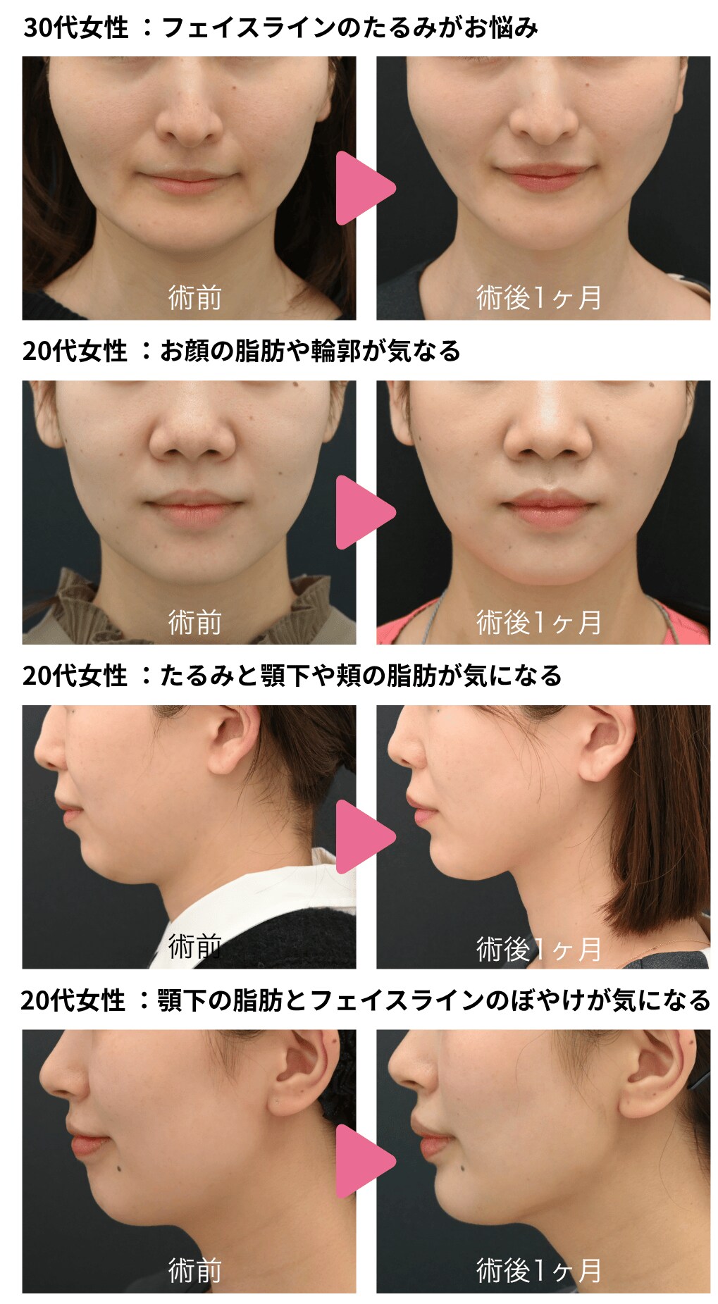 脂肪吸引と糸リフトを組み合わせた最新治療