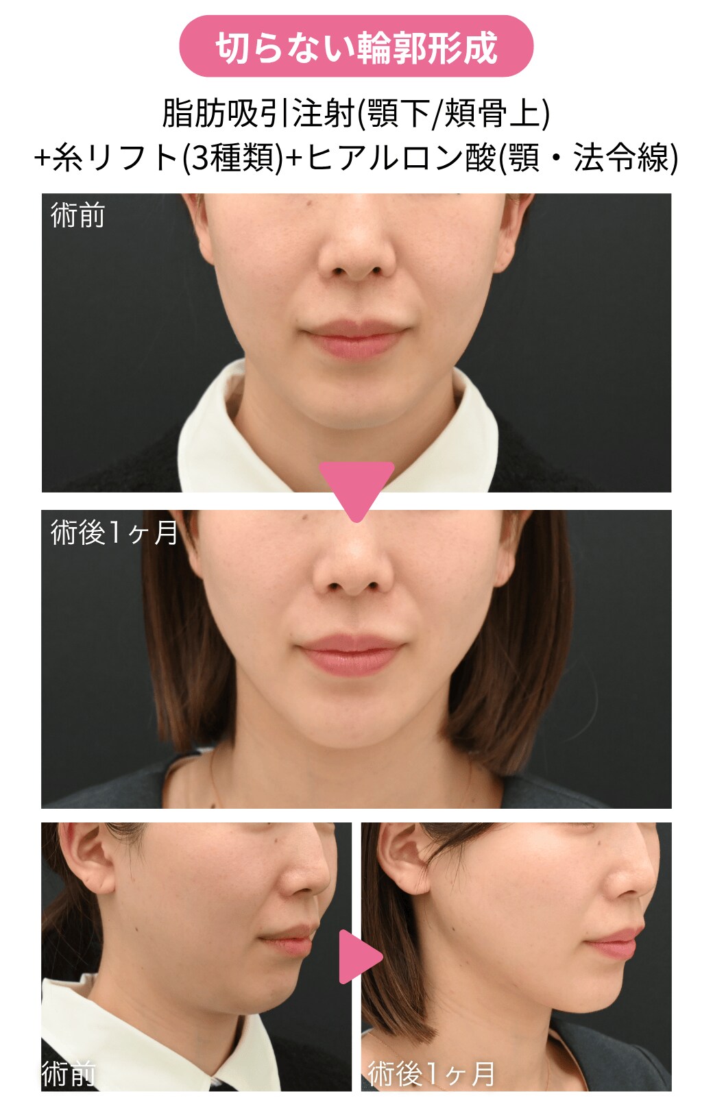 ▶︎ 20代後半女性｜脂肪吸引注射＋糸リフト＋ヒアルロン酸