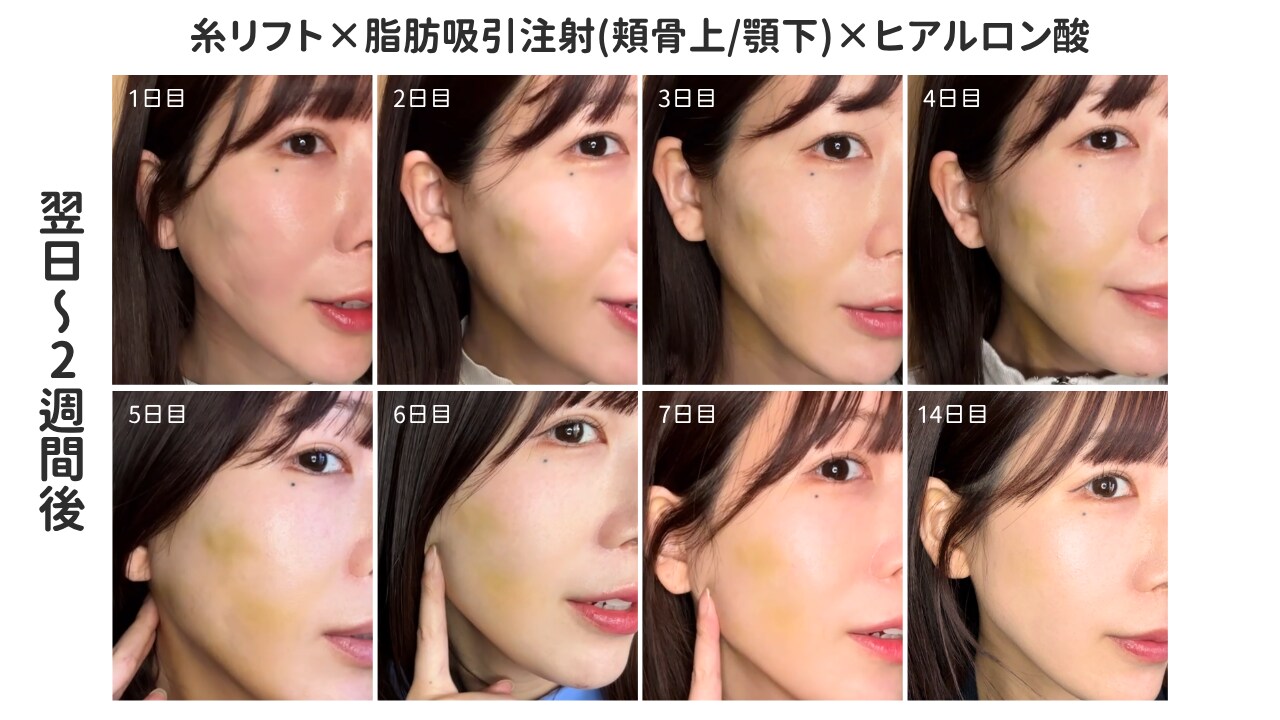 Q1. 輪郭形成のダウンタイムは？