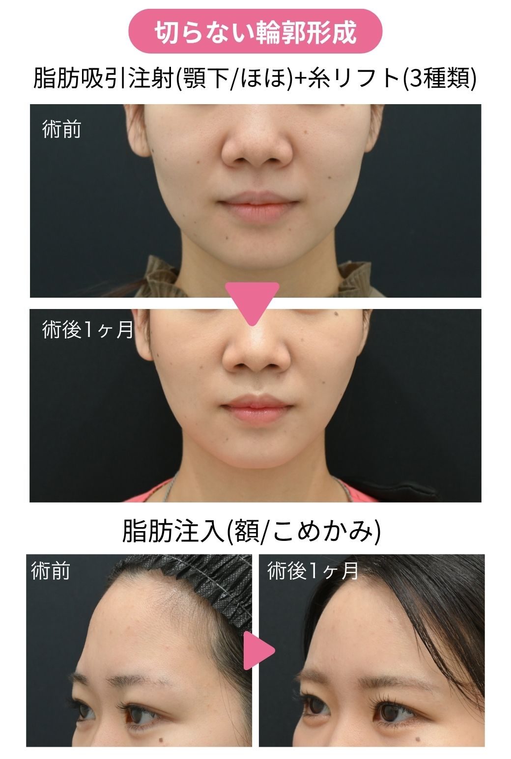 ▶︎ 20代後半女性｜脂肪注入＋脂肪吸引注射＋糸リフト
