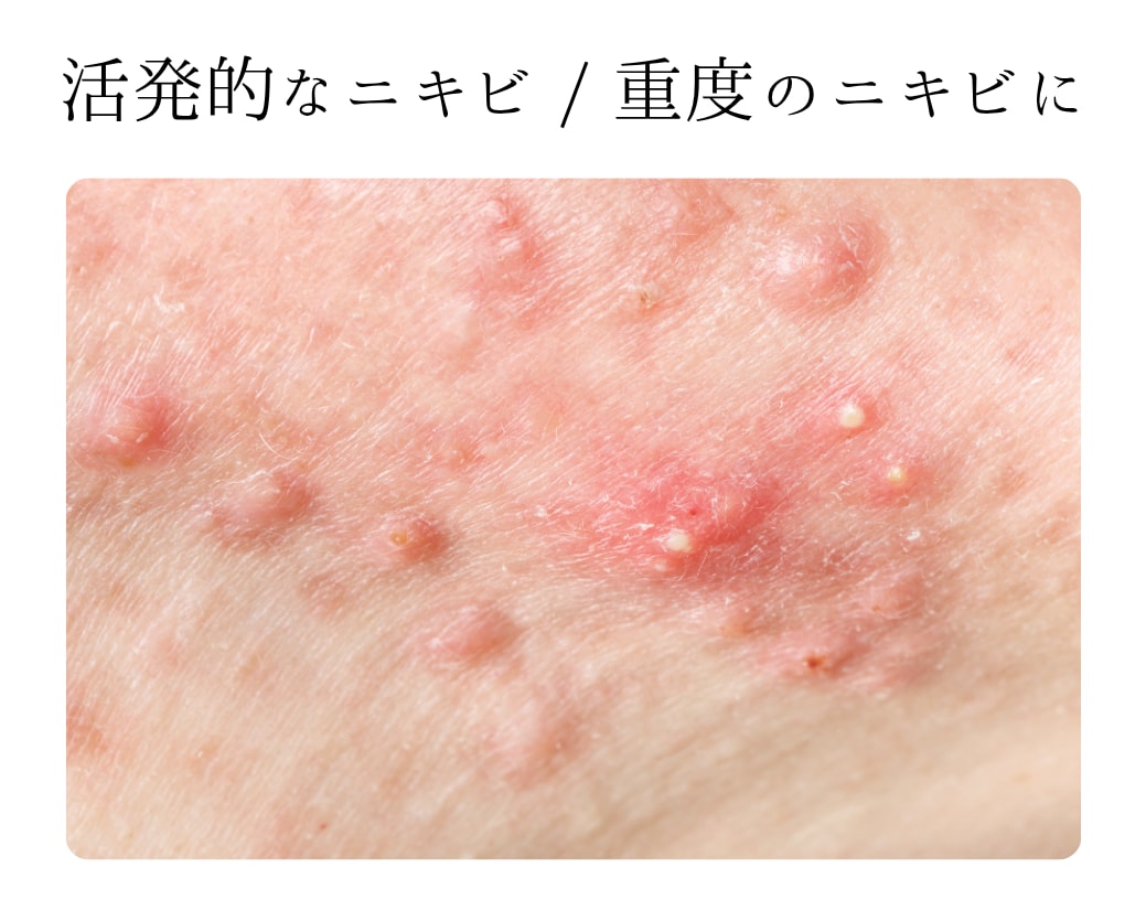 アクネトレント×ベビースキンによるW治療