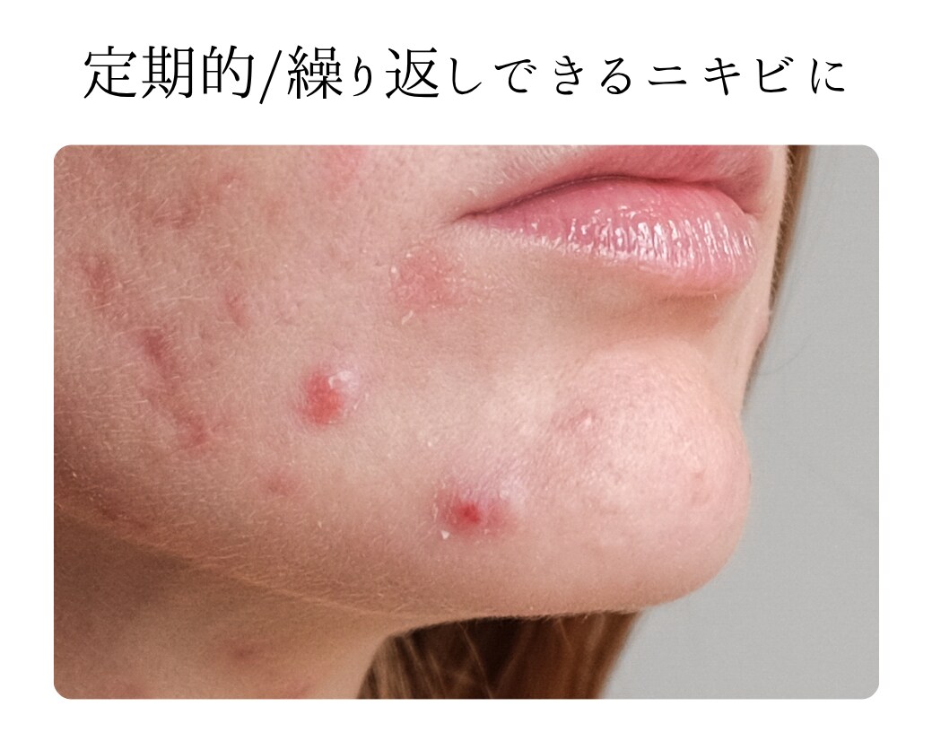 IPL光治療アクネライトの特徴と効果