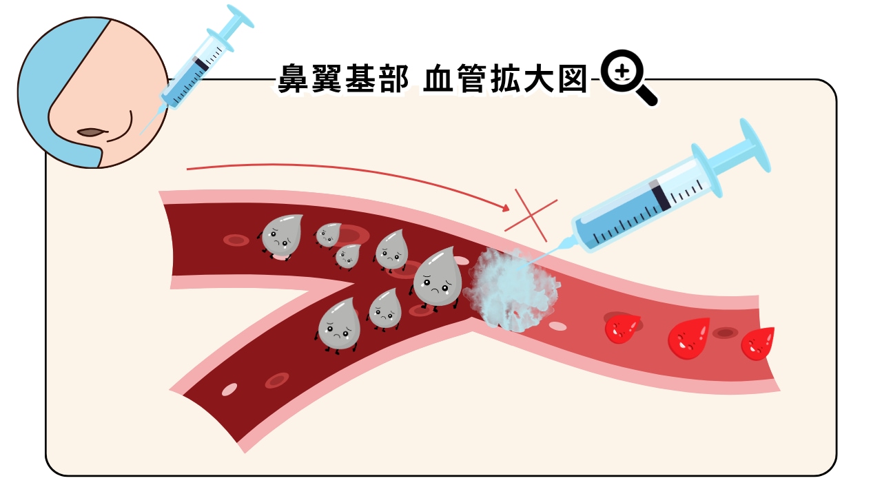 貴族フィラーはリスクが高い？