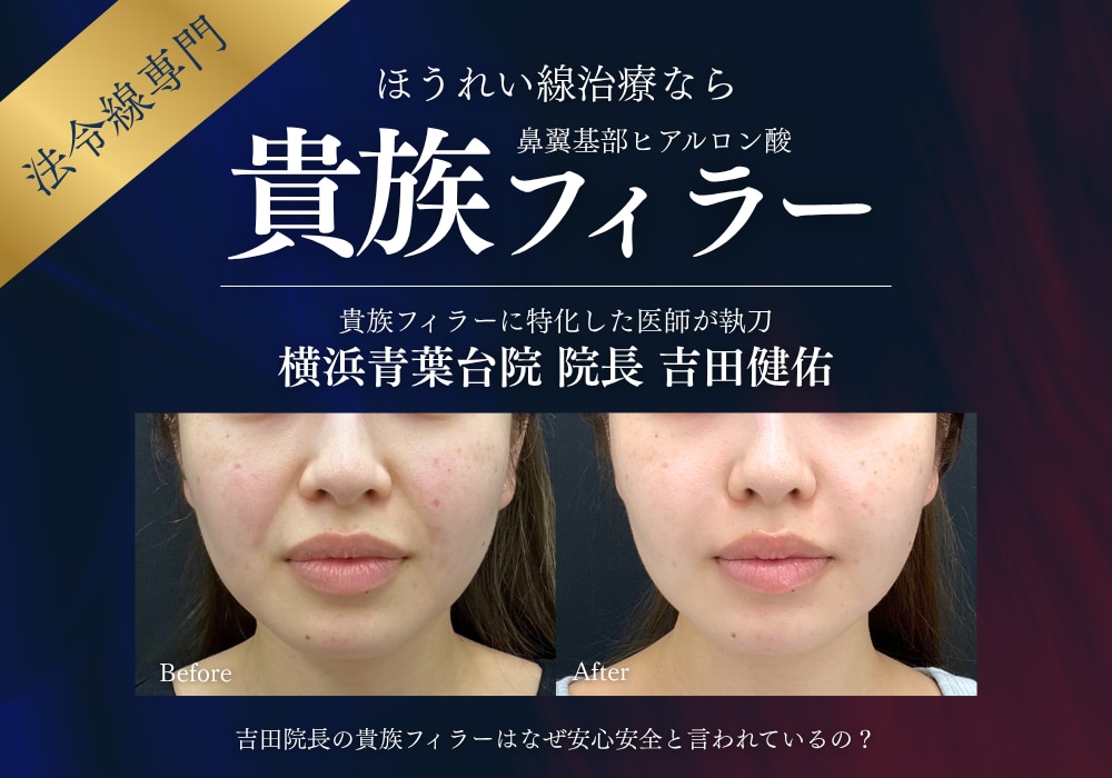 【ほうれい線治療】話題の貴族フィラー・貴族ヒアルで自然に若返り｜湘南美容クリニック横浜青葉台院