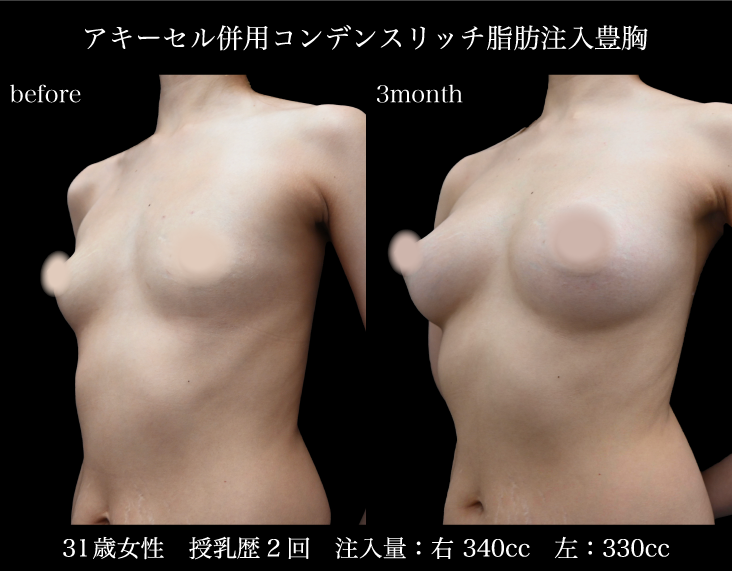 プレミアムドクターによる豊胸術