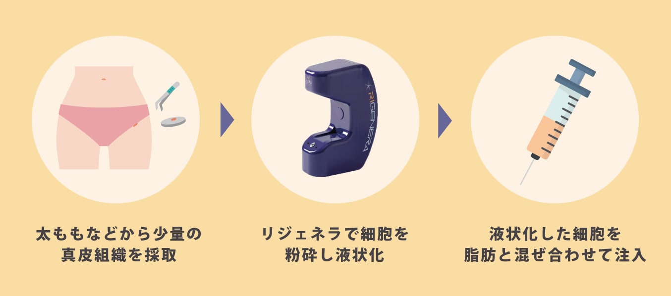 リジェネラとは？