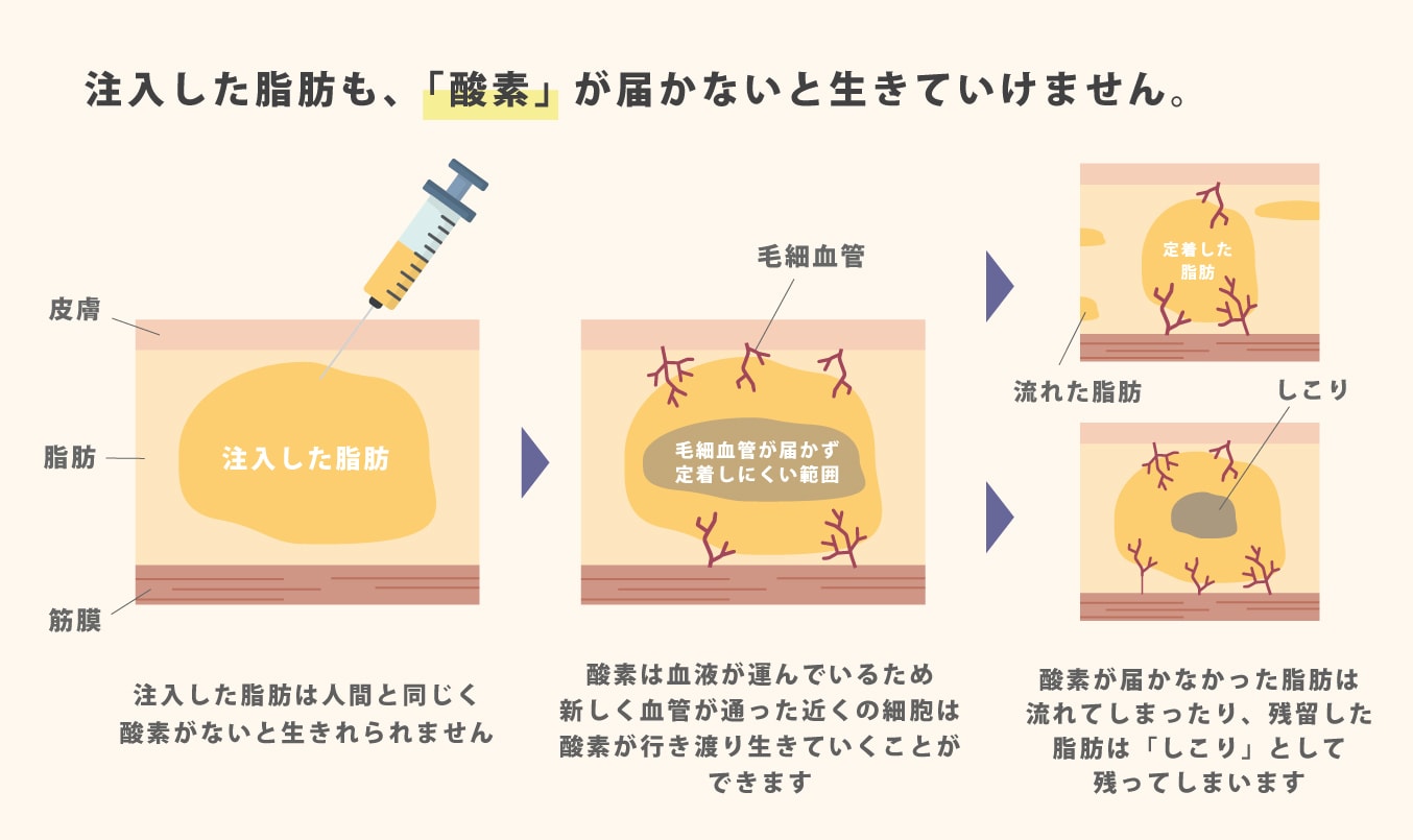 どうして定着しない脂肪があるの？