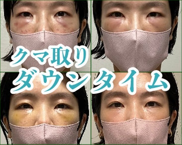【横浜でクマ取り】術直後〜経過大公開！ダウンタイムを軽減させる方法とは