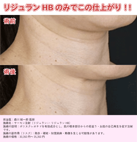 保湿力が欲しい方に！ヒアルロン酸配合<br />
＜リジュランHB＋ボトックス＞