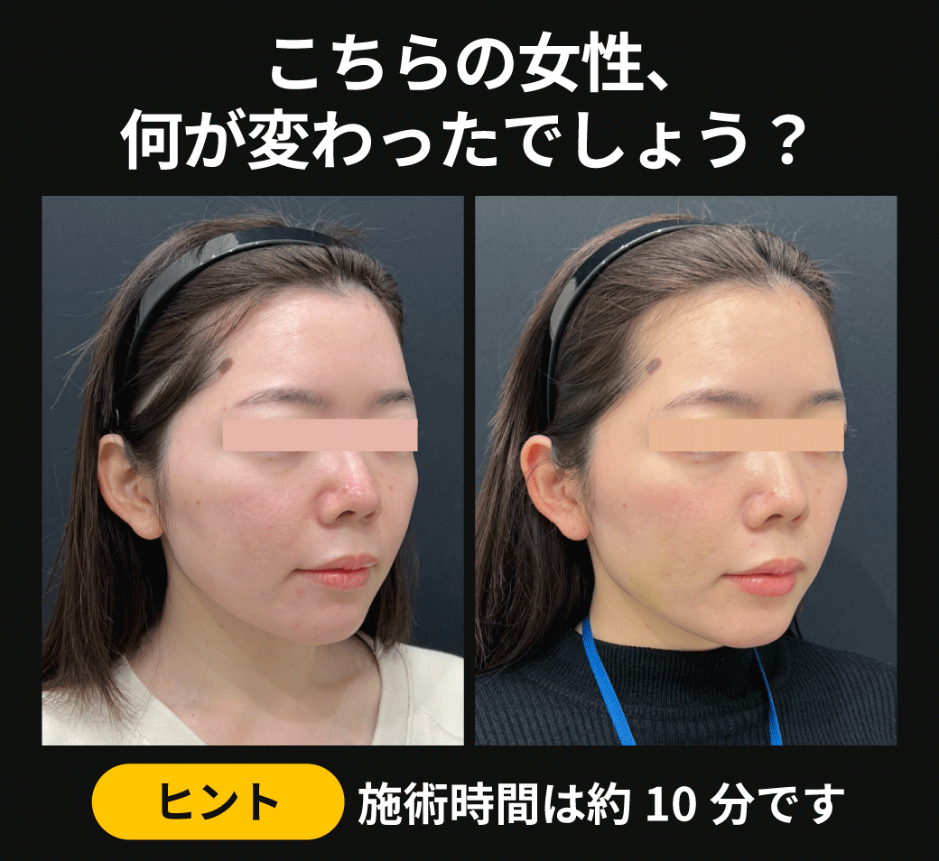 【たるみ治療】2週間で激変‼️日に日に輪郭が引き締まるリピーター続出の若返り治療⁉️｜関東・神奈川エリア