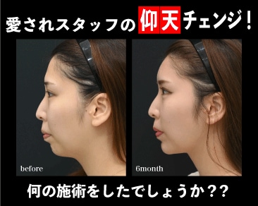 【横浜で脂肪吸引】美を追求するスタッフの仰天チェンジ!