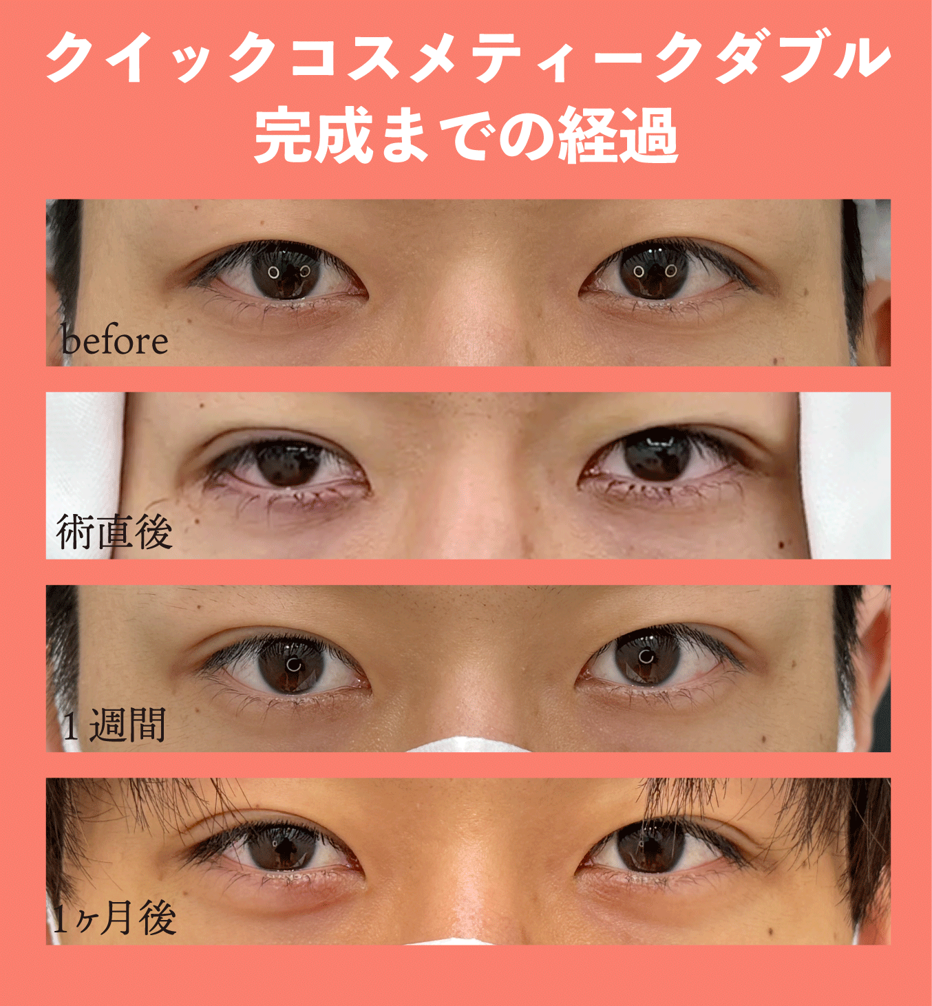 QCWなら腫れ最小！