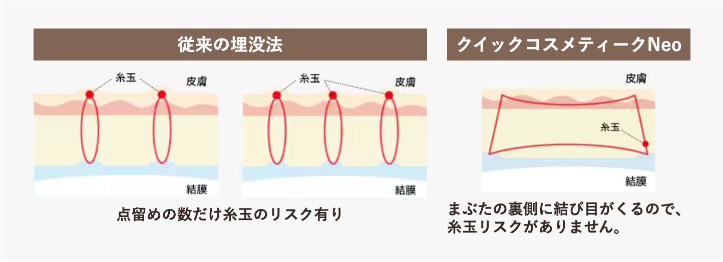 埋没法｜クイックコスメティーク・ダブルneo