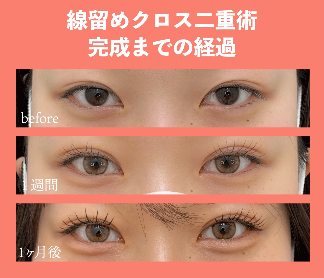 線留めクロス二重術で取れづらい二重に