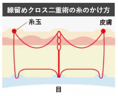 埋没法｜線留めクロス二重術