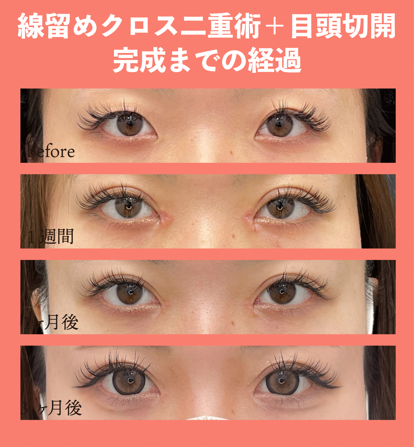 二重と目頭切開の併用で垢抜け目元に