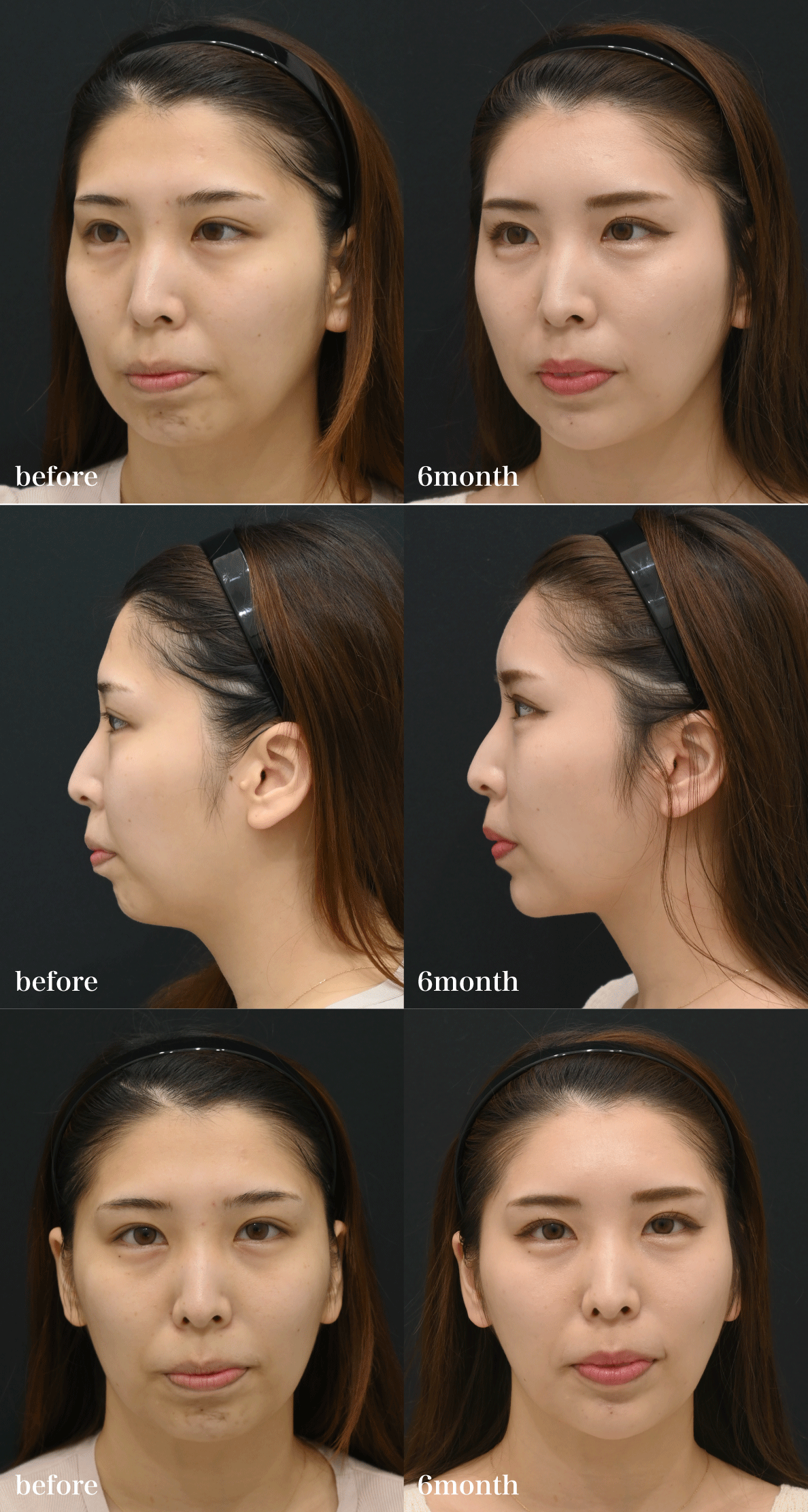 まずは美しすぎる<br />
Before／After