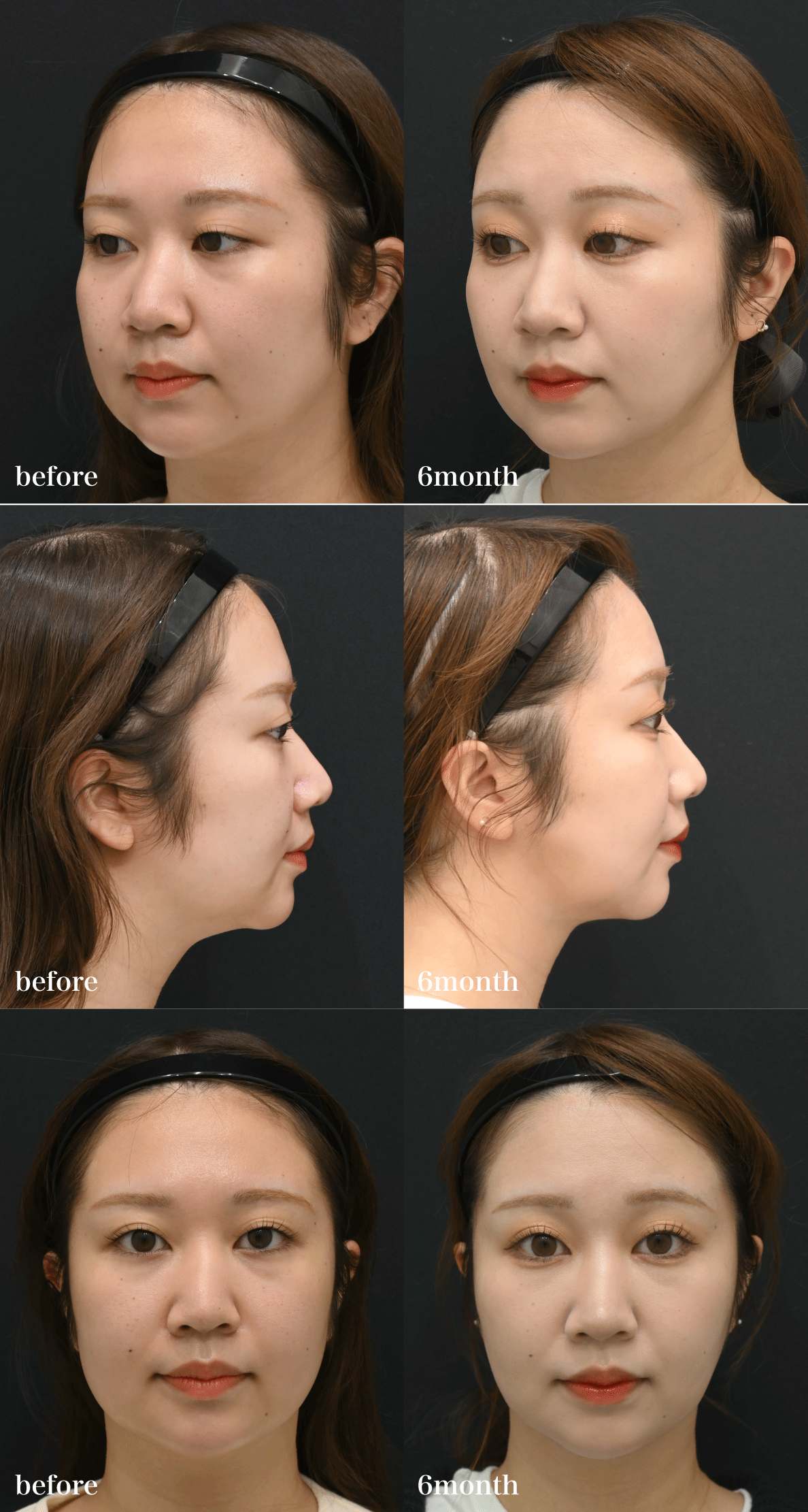 まずは美しすぎる<br />
Before／After