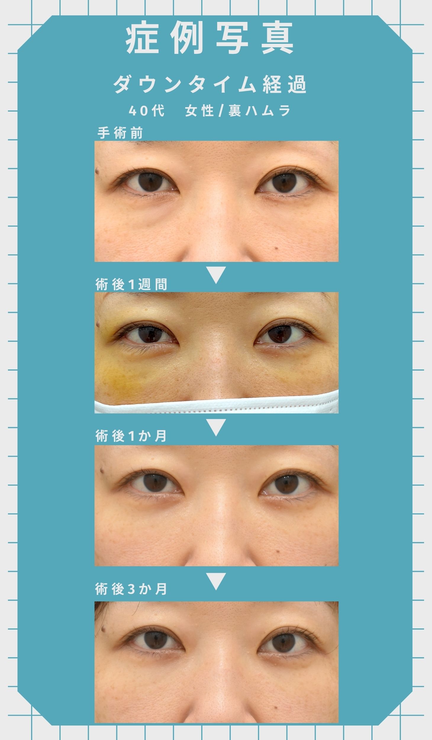 気になるダウンタイムは？