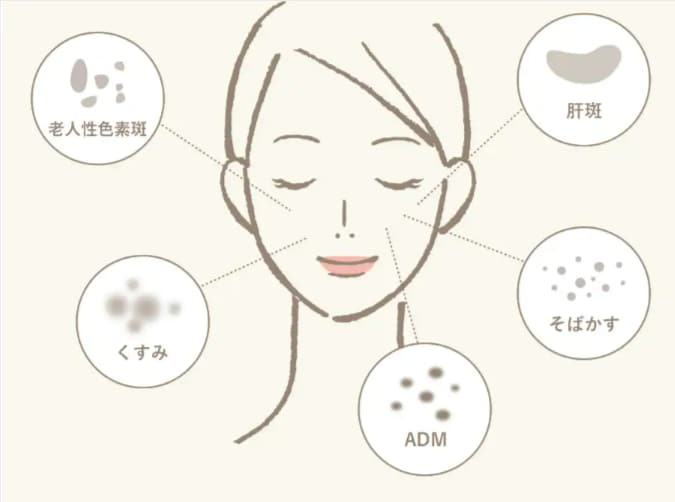 シミの種類と治療方法<br />
