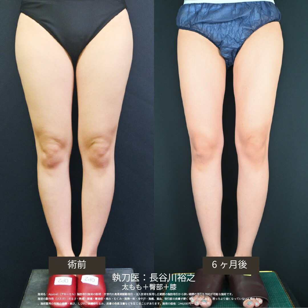 脂肪吸引をSBC横浜院で受ける理由とは？