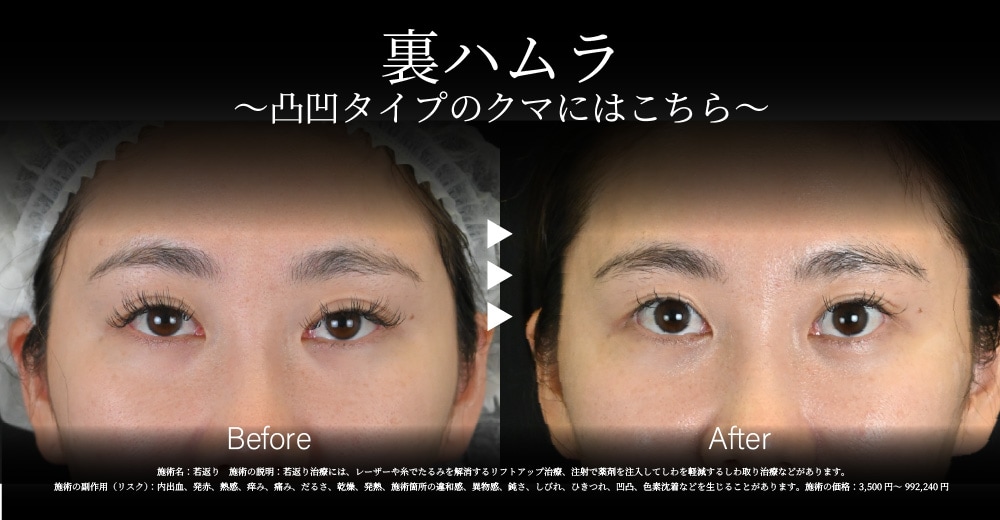 凸凹タイプのくまには「裏ハムラ」が最適<br />
