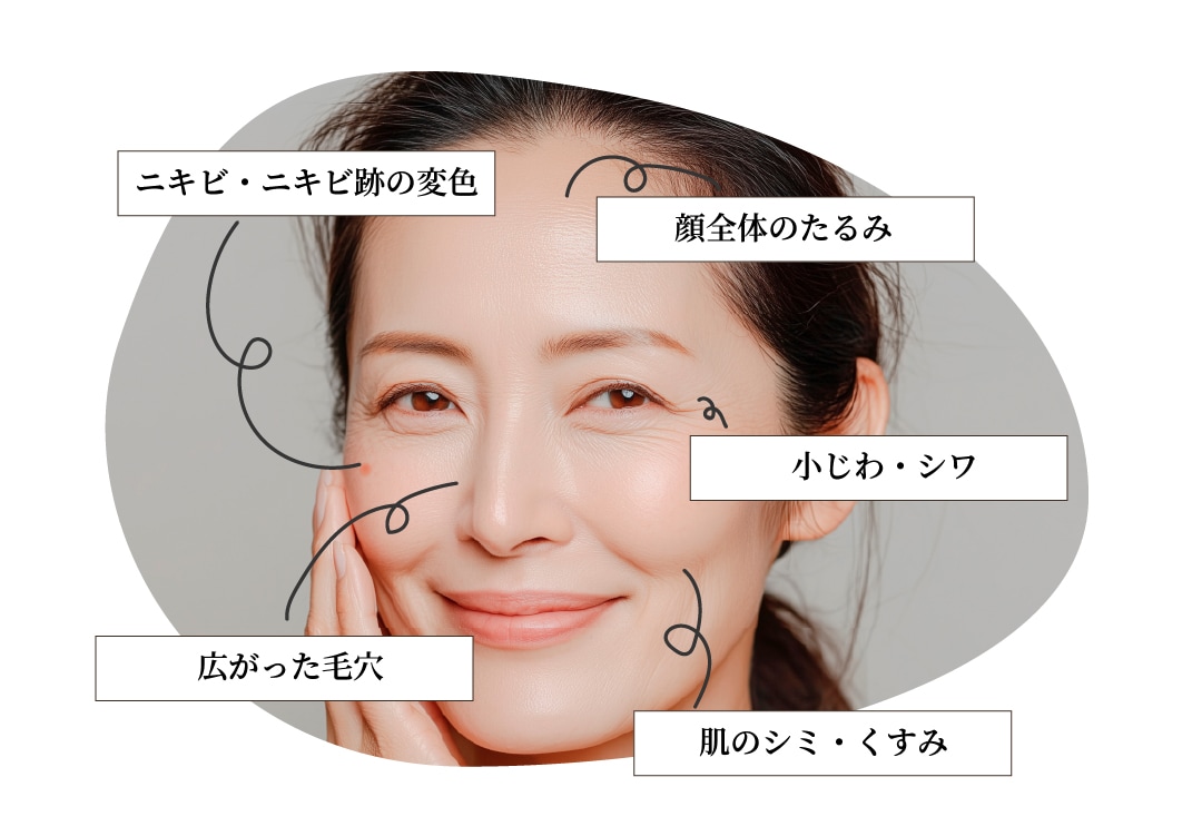 ニキビ・ニキビ跡の変色<br />
