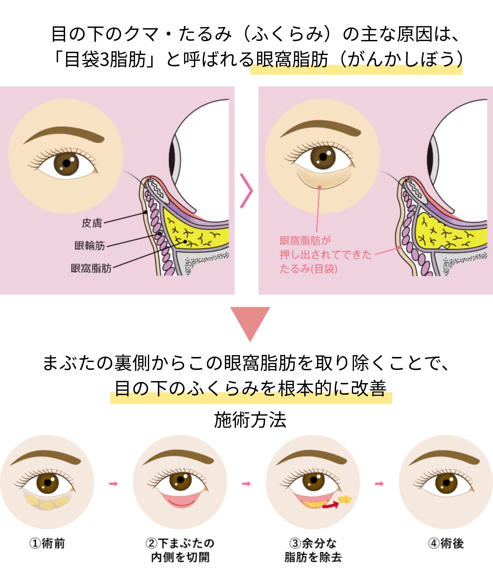 話題の「切らないクマ取り」とは？