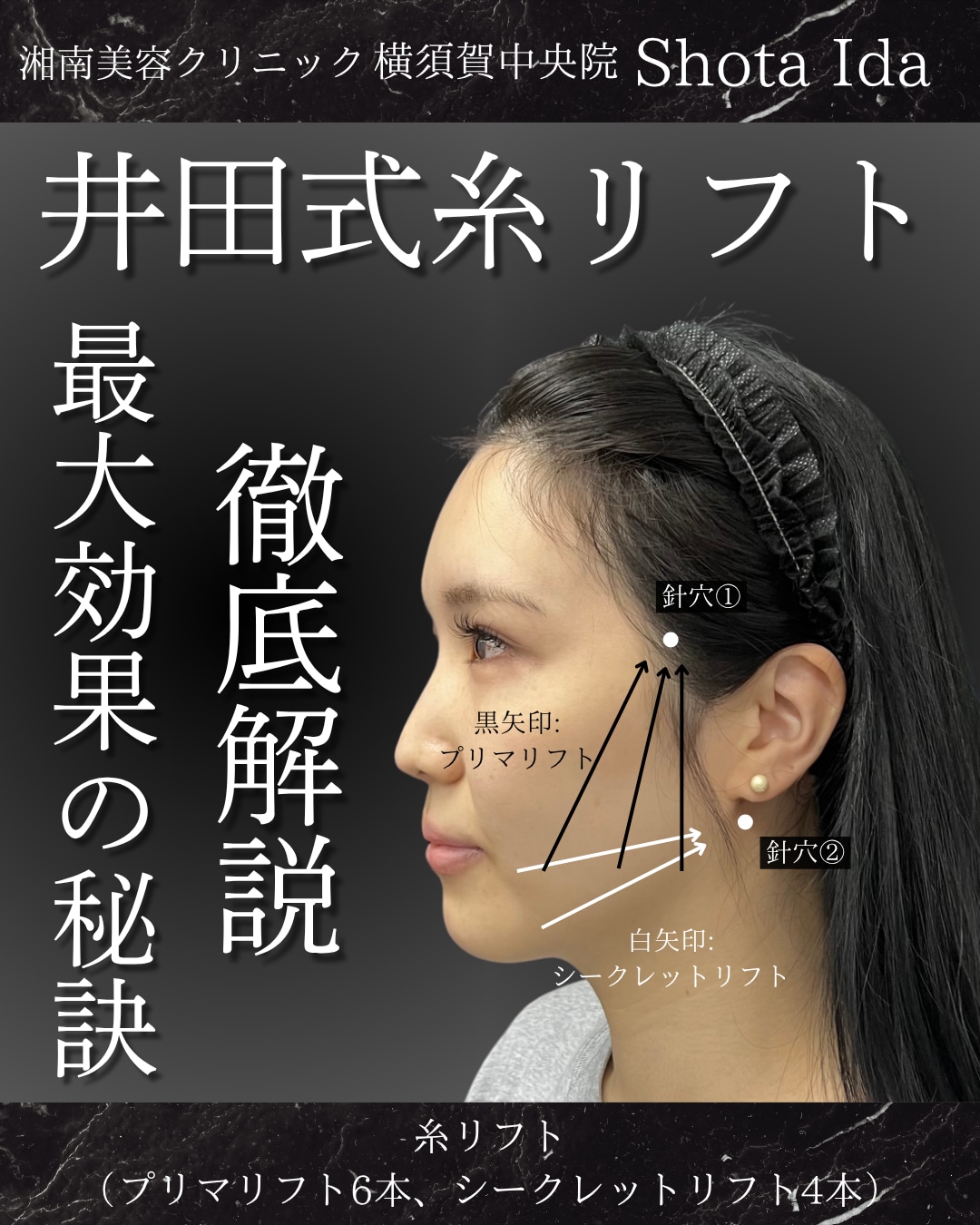 【井田式糸リフト】徹底解説!最大効果の秘訣は◯◯