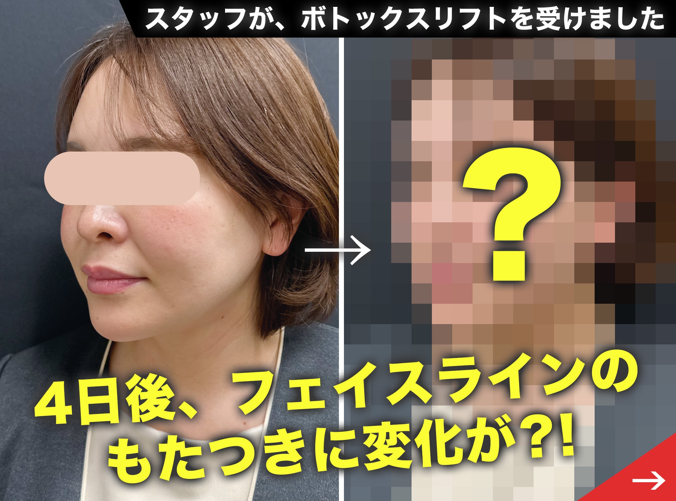 冬の強張りをリセット！2月からはじめるボトックスリフト習慣