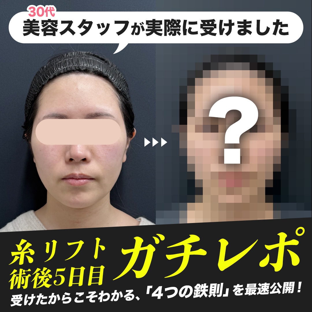 【緊急特集】糸リフト術後5日目のリアル!後悔しない為に、スタッフが今すぐ伝えたい「4つの鉄則」