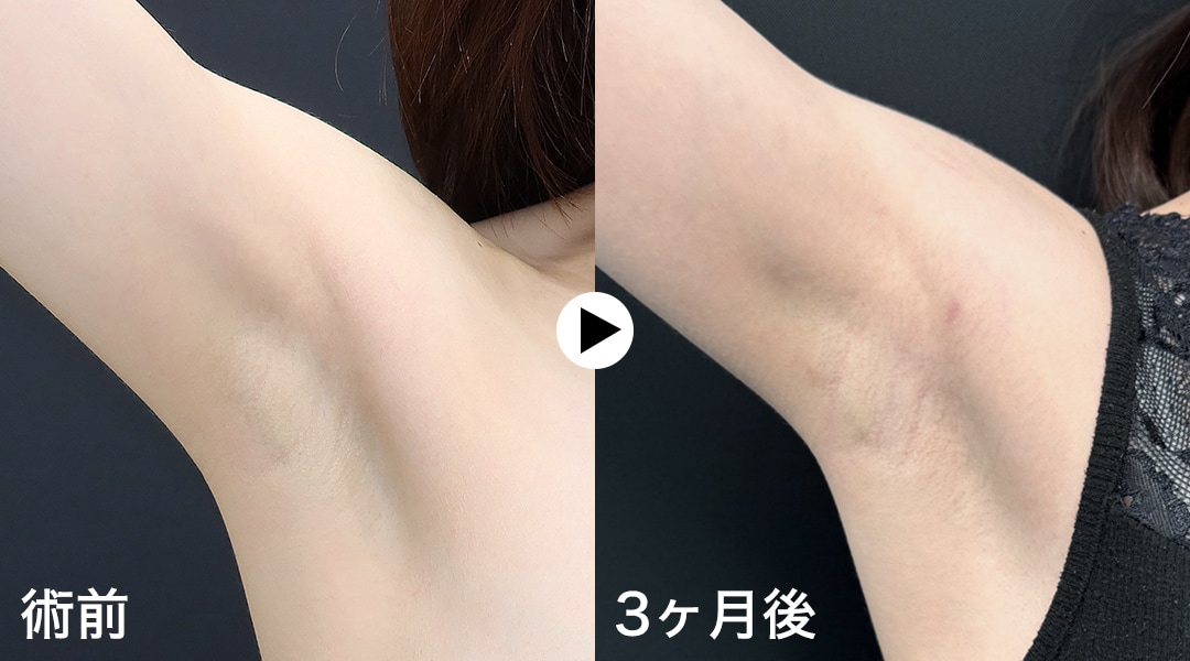 ① 傷跡が目立ちにくい、審美性へのこだわり