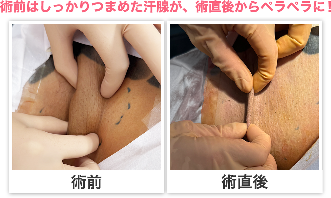 根こそぎベイザーシェービング法