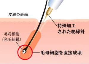 ニードル脱毛の仕組み 