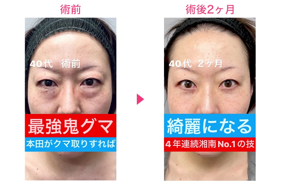 before after