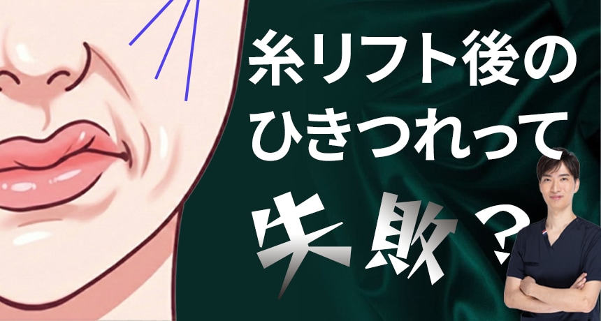 糸リフト後のひきつれって失敗？
