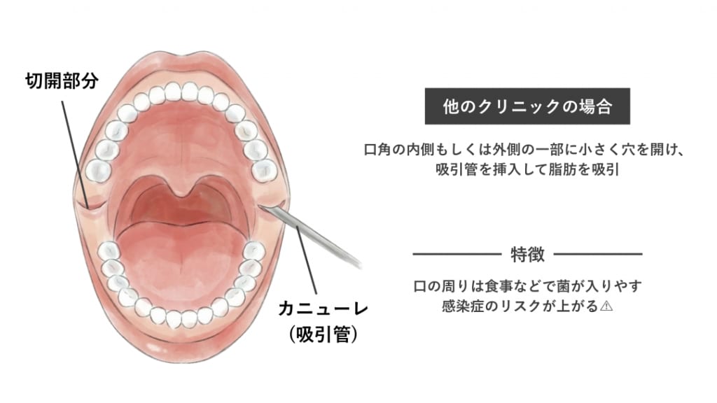 メーラー・ナゾラビアル　吸引管挿入イメージ(他院)