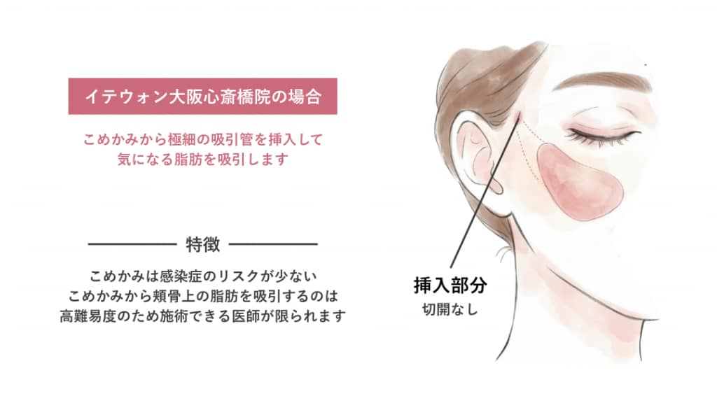 メーラー・ナゾラビアル　吸引管挿入イメージ(他院)
