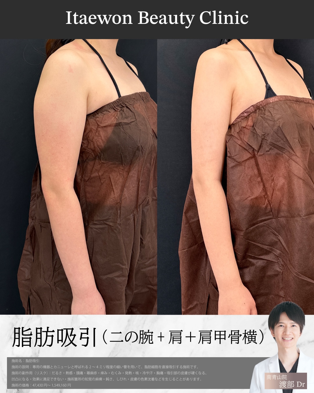 二の腕2