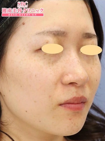 わきボトックス 症例写真 After