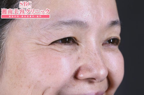 ナチュラルボトックス 症例写真 After