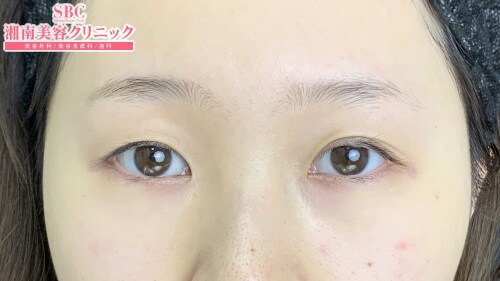 {クイックコスメティークダブルNeo} {20代}  {女性} の術前の症例写真