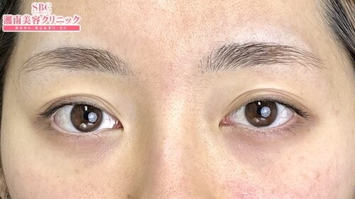 {フォーエバー二重術} {20代}  {女性} の術前の症例写真