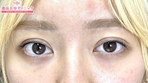 {フォーエバー二重術} {20代}  {女性}  の術後の症例写真