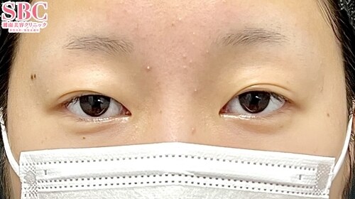 {フォーエバー二重術} {20代}  {女性} の術前の症例写真